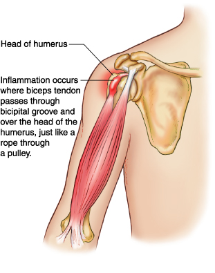 biceps%20tendonitis